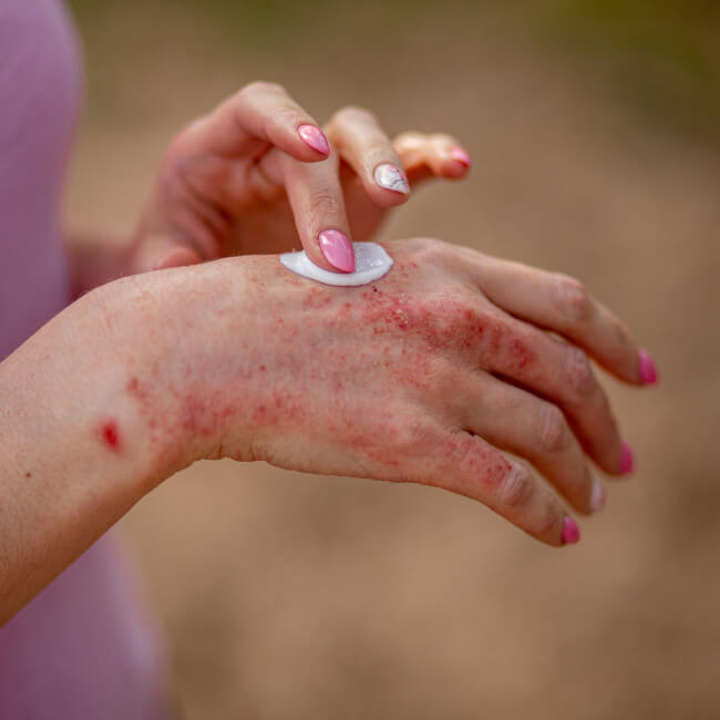 Atopowe zapalenie skóry (AZS) – objawy, przyczyny, leczenie, czy to alergia, emolienty
