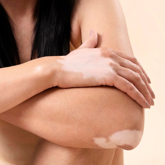 Bielactwo nabyte – objawy, przyczyny, leczenie. 9 porad dla osób z bielactwem